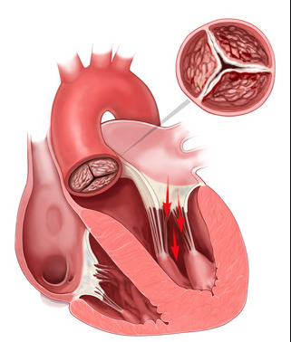 Sostituzione Valvola Aortica Percutanea